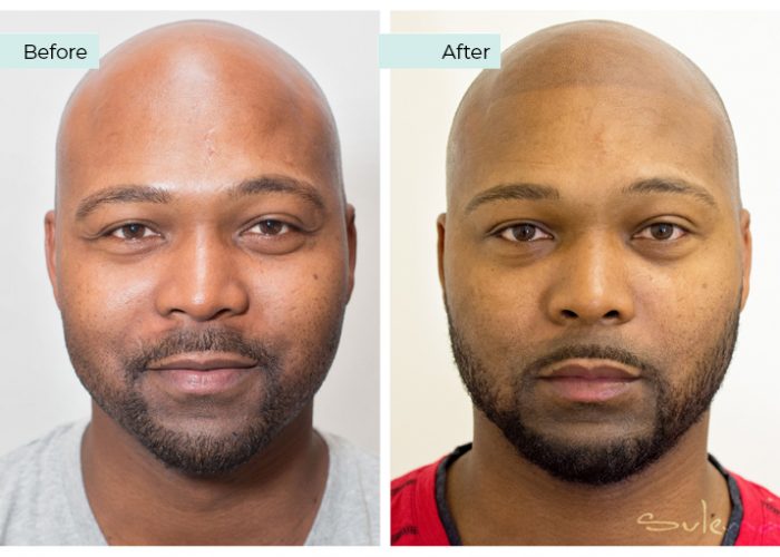 Scalp Micropigmentation 01