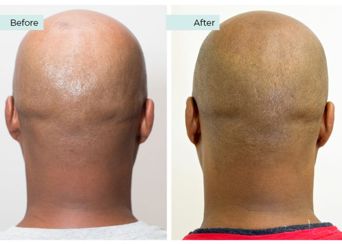 Scalp Micropigmentation 02