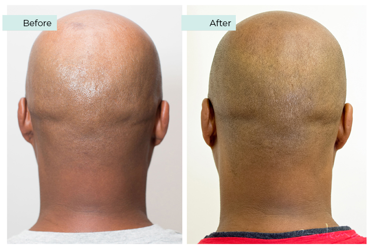 CDA Scalp Micropigmentation