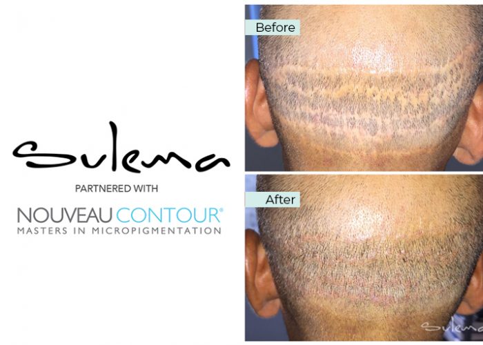 Scalp Micropigmentation Scar 01