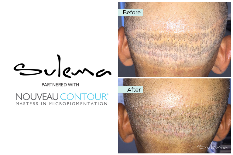 CDA Scalp Micropigmentation Scar